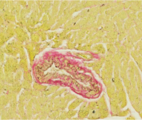 Microscopic image of a blood vessel with fibrosis after immune checkpoint deactivation, surrounded by tissue.