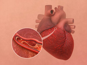 Illustration of a human heart with a highlighted coronary artery. An enlarged view shows a spontaneous coronary artery dissection (SCAD) with bleeding and separation of the vessel wall, causing narrowing of the blood flow.