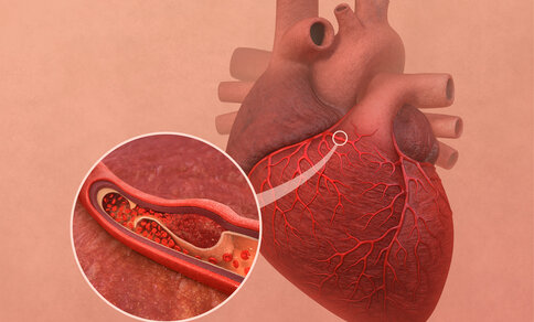 Illustration of a human heart with a highlighted coronary artery. An enlarged view shows a spontaneous coronary artery dissection (SCAD) with bleeding and separation of the vessel wall, causing narrowing of the blood flow.