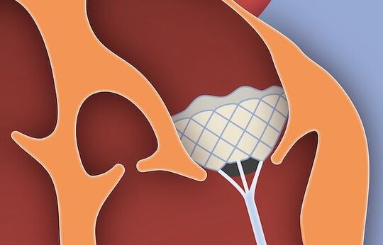 Transapikale Implantation eines Mitralklappen-stents ohne Einsatz einer Herz-Lungen-Maschine