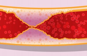 In vivo Charakterisierung des Chemokinrezeptors CXCR4 zur Detektion einer Entzündung in atherosklerotischen Plaques mittels PET/MR