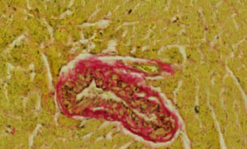 Mikroskopische Aufnahme eines Blutgefäßes mit Fibrose nach Deaktivierung des Immun-Checkpoints, umgeben von Gewebe.