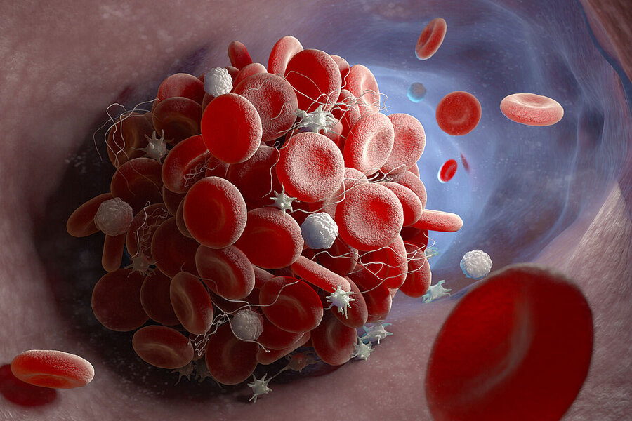 3D illustration of a blood clot forming: red blood cells, platelets and fibrin strands clump together inside a blood vessel