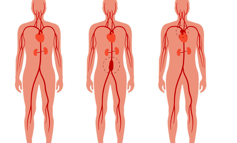 Diagram showing a healthy aorta, an abdominal aortic aneurysm, and a thoracic aortic aneurysm in human figures