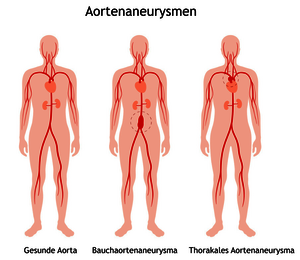 Diagram showing a healthy aorta, an abdominal aortic aneurysm, and a thoracic aortic aneurysm in human figures