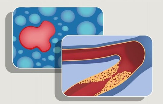 Detektion des instabilen atherosklerotischen Plaque mittels kombinierter NIRF-IVUS Bildgebung