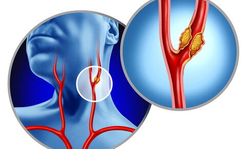 Illustration showing a human neck with highlighted carotid arteries. A close-up depicts a blockage in one artery. 