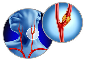 Illustration showing a human neck with highlighted carotid arteries. A close-up depicts a blockage in one artery. 