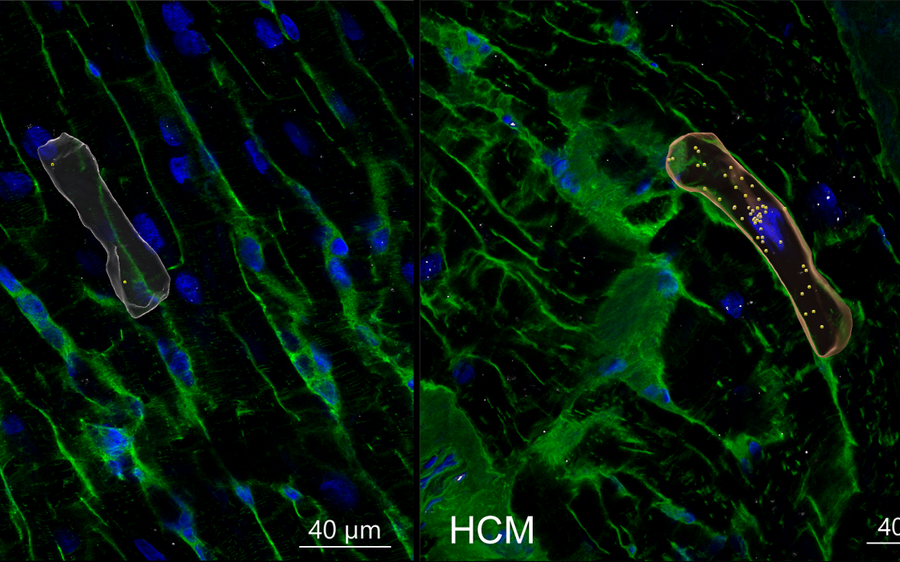 Fluorescence microscopy image of cardiac muscle tissue (green: cell structure, blue: cell nuclei), each panel showing one elongated cell highlighted in false colour (white on the left, red with yellow markers on the right). The right-hand image is labelled "HCM" and shows tissue from hypertrophic cardiomyopathy, compared with the control image on the left. Scale bar: 40 µm.
