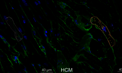Fluoreszenzmikroskopische Aufnahme von Herzmuskelgewebe (grün: Zellstruktur, blau: Zellkerne) mit jeweils einer hervorgehobenen, länglichen Zelle in Falschfarben (links weiß, rechts rot mit gelben Markierungspunkten). Die rechte Aufnahme ist mit „HCM" beschriftet und zeigt Gewebe bei hypertropher Kardiomyopathie im Vergleich zur linken Kontrollaufnahme. Maßstabsbalken: 40 µm