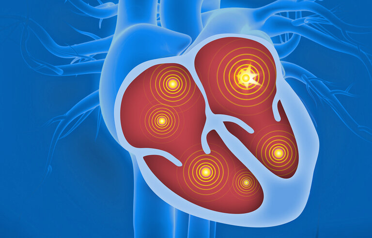 CAtheter-Based Ablation of atrial fibrillation compared to conventional treatment in patients with Heart Failure with Preserved Ejection Fraction (CABA-HFPEF-DZHK27)