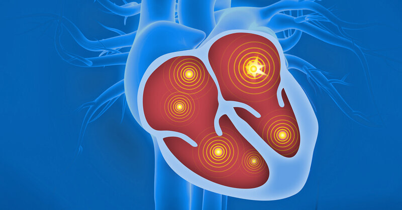 CABA-HFPEF-DZHK27 - CAtheter-Based Ablation of atrial fibrillation compared to conventional treatment in patients with Heart Failure with Preserved Ejection Fraction (CABA-HFPEF-DZHK27)