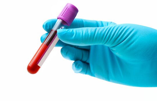 Characterization of lipidome dynamics in anthracycline-induced cardiotoxicity