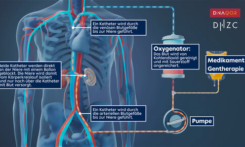 Diagram showing a medical process where blood is filtered with an oxygenator, pumped, treated with medication or gene therapy, and returned to the body via catheters near the kidneys.