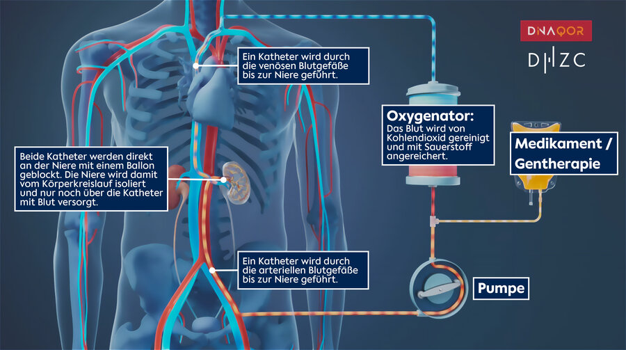 Diagram showing a medical process where blood is filtered with an oxygenator, pumped, treated with medication or gene therapy, and returned to the body via catheters near the kidneys.