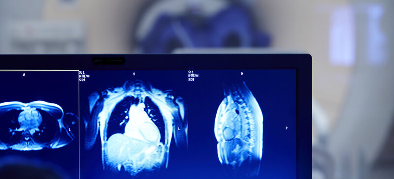 HFpEF-stress-DZHK17 - Cardiovascular magnetic resonance real time exercise stress testing in heart failure with preserved ejection fraction (HFpEF-stress-DZHK17)