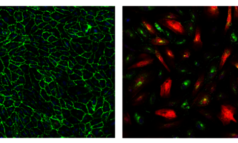 Endothelial cells under a fluorescence microscope: left, healthy tightly packed cells (green); right, cells pathologically transformed into connective-tissue-like cells (red) that have lost cohesion.