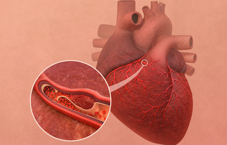 Spontaneous Coronary Artery Dissection - AntipLatelet therapy Intensity in Guided coNservative management (SCAD-ALIGN-DZHK31)