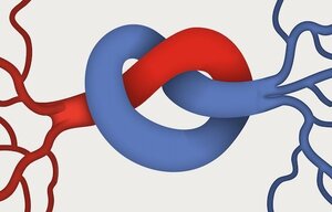 rAAV.MRTF-A-basierte vaskuläre Gentherapie bei der chronischen Ischämie der Extremitäten