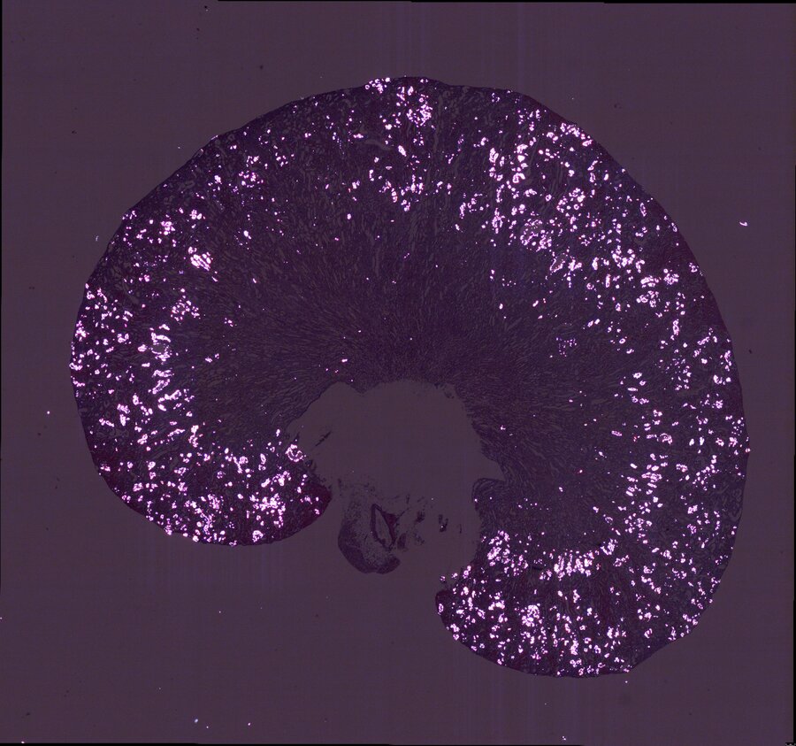 Microscopic image of a kidney tissue cross-section under polarised light against a dark purple background. Numerous brightly glowing white-pink crystal deposits of oxalate are scattered throughout the outer, arc-shaped region (renal cortex), while the central area remains dark and free of deposits.