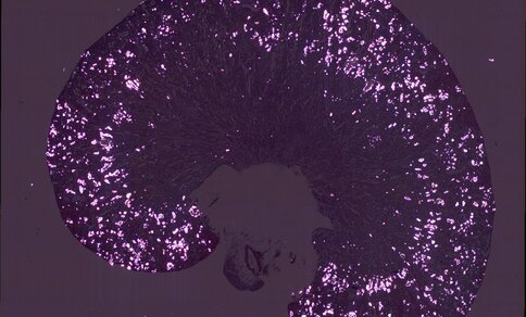 Microscopic image of a kidney tissue cross-section under polarised light against a dark purple background. Numerous brightly glowing white-pink crystal deposits of oxalate are scattered throughout the outer, arc-shaped region (renal cortex), while the central area remains dark and free of deposits.