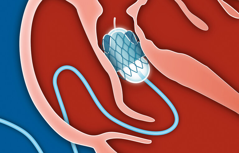 A first-in-human feasibility study to evaluate the safety (and short term effectiveness) of the autologous GrOwnValve transcatheter pulmonary heart valve (GECT-DZHK28)
