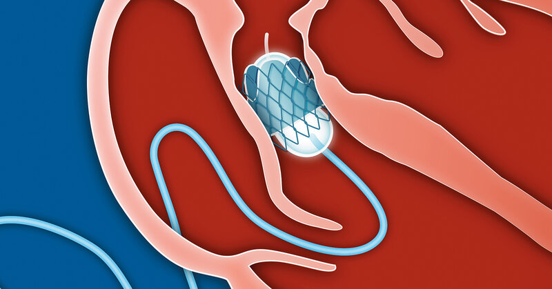 GECT-DZHK28 - A first-in-human feasibility study to evaluate the safety (and short term effectiveness) of the autologous GrOwnValve transcatheter pulmonary heart valve (GECT-DZHK28)