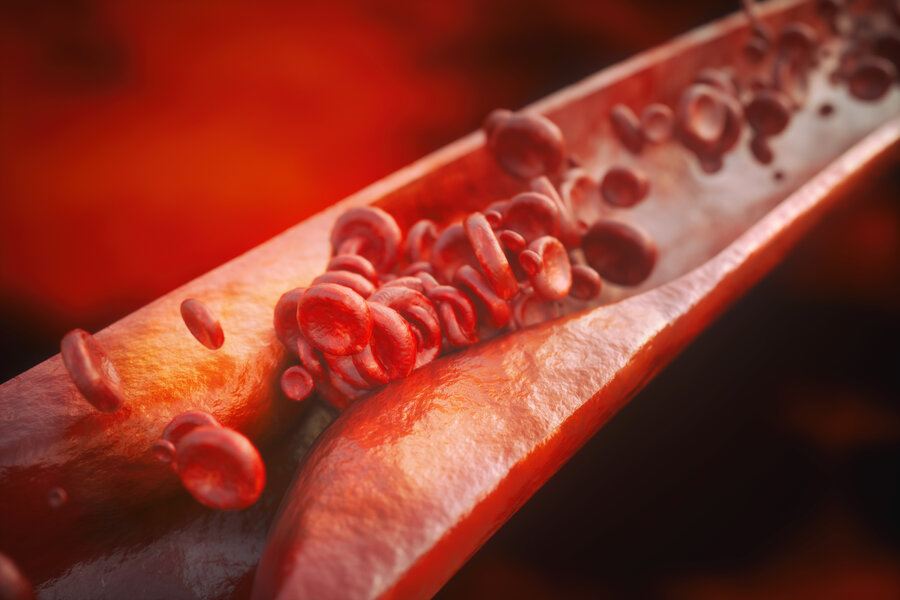 Illustration of red blood cells flowing through a narrowed artery, suggesting restricted blood flow due to plaque buildup.