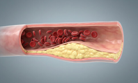 Cross-section of a blood vessel with atherosclerotic plaque severely narrowing the vessel lumen.