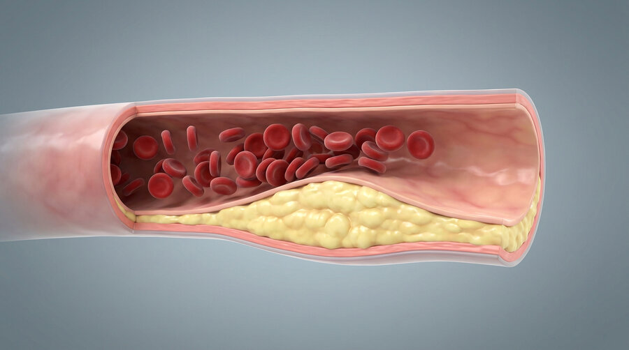Cross-section of a blood vessel with atherosclerotic plaque severely narrowing the vessel lumen.
