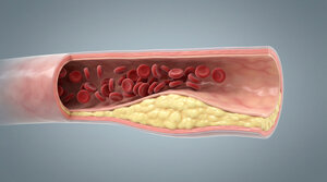 Cross-section of a blood vessel with atherosclerotic plaque severely narrowing the vessel lumen.