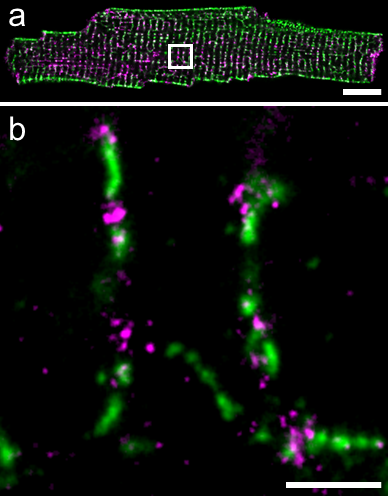 Zwei STED-mikroskopische Bilder einer Herzmuskelzelle mit pinkfarbenen und grünen Einfärbungen. Pink kennzeichnete das Membranreparaturprotein Dysferlin. Grün kennzeichnet das Membrannetzwerk innerhalb der Muskelzelle. Das zweite Bild ist eine Vergrößerung des ersten Bildes.