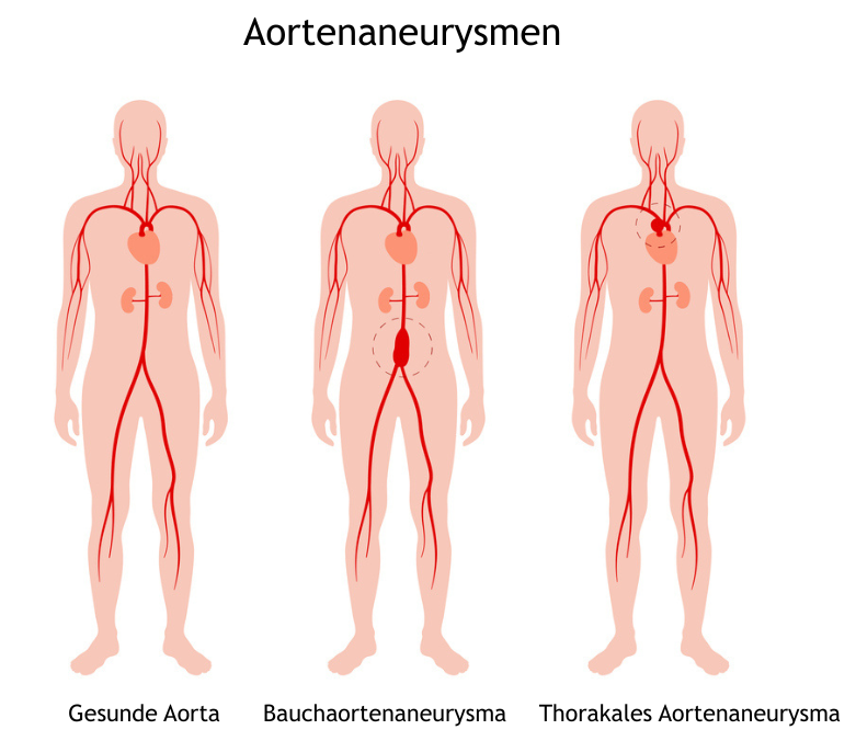 Diagram showing a healthy aorta, an abdominal aortic aneurysm, and a thoracic aortic aneurysm in human figures